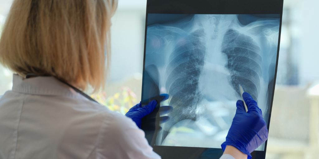 Alentejo com número residual de casos de Tuberculose Multirresistente em 2024